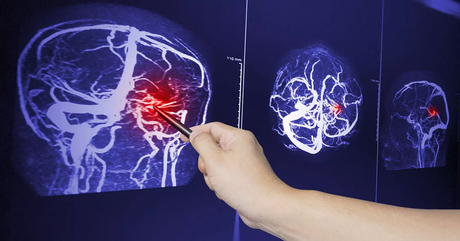 TBI detects on a MRI scan