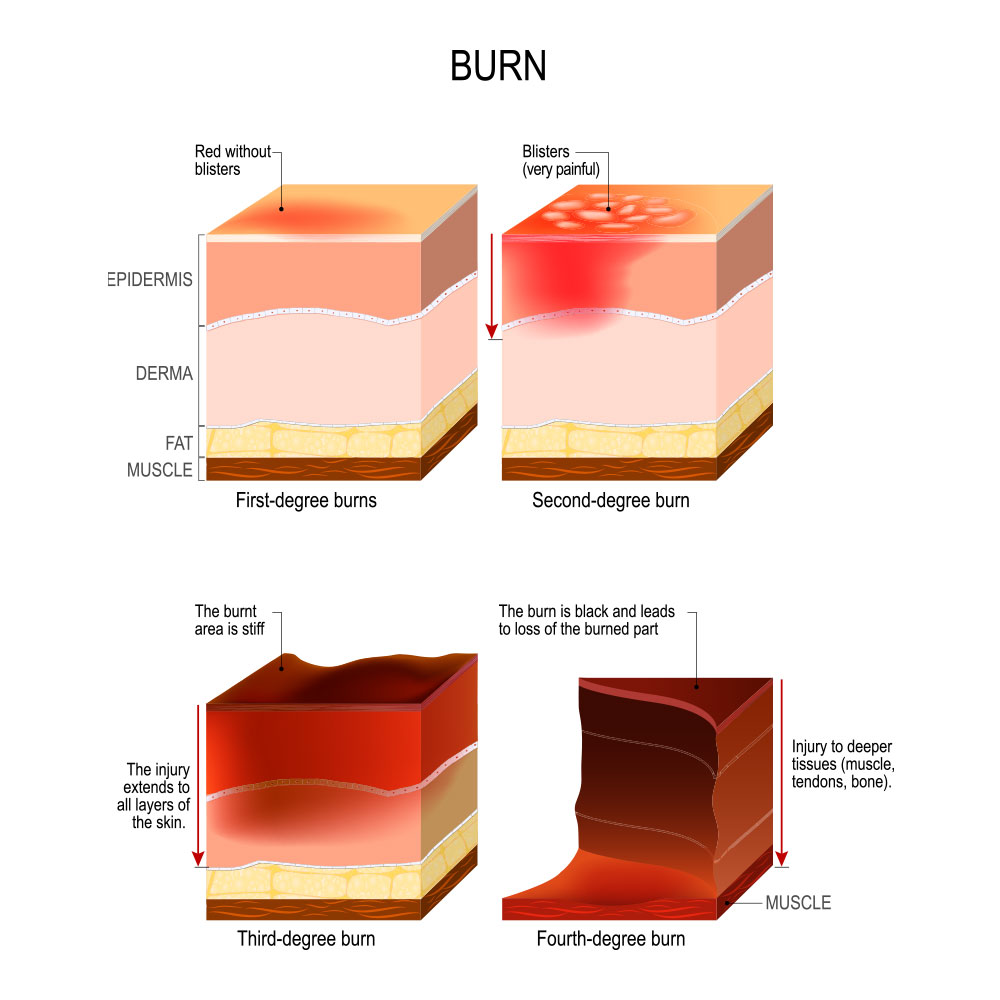 types-of-burn-injuries-attorneys-houston-texas